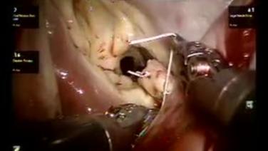 Mitral Valve Repair (MVR) - Leaflet Resection & Suturing