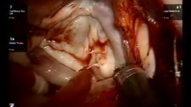 Mitral Valve Repair (MVR) - Leaflet Testing