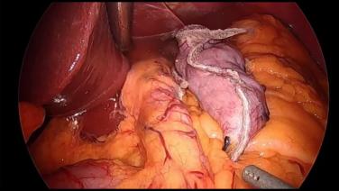 Laparoscopic Sleeve Gastrectomy - Perform Air Leak Test