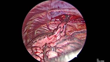 Thorascopic Lobectomy - Manual palpation