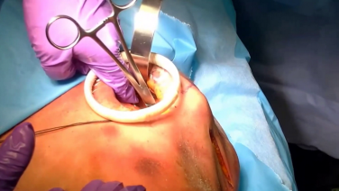 MatrixRIB posterior