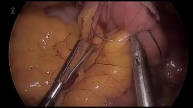 Laparoscopic Roux-en-Y Gastric Bypass - Closure of Mesenteric Defect