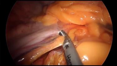 Laparoscopic Sleeve Gastrectomy - Mobilize Greater Curvature