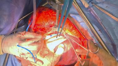 Right Hepatectomy - Mobilize Liver