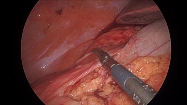 Laparoscopic Right Hemicolectomy - Ligate & Divide Right Middle Colic Vessels