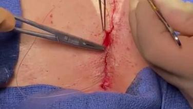 Mitral Valve Repair (MVR) - Closure Monocryl 2/3