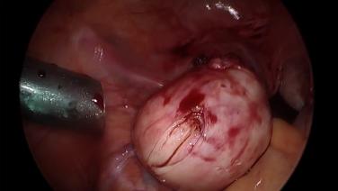 Laparoscopic Myomectomy - Myoma Vessel Control