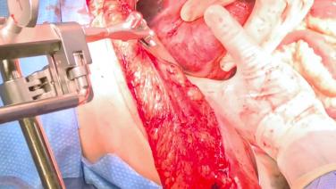 Right Hepatectomy - Outflow Control