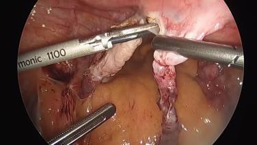 Total Laparoscopic Hysterectomy - Transect Utero-Ovarian Ligaments