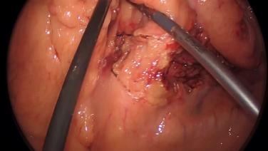 Laparoscopic Low Anterior Resection - Pelvic Dissection