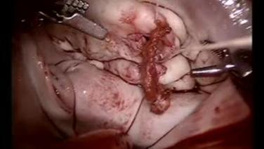 Mitral Valve Repair (MVR) - Pericardial Patch Repair