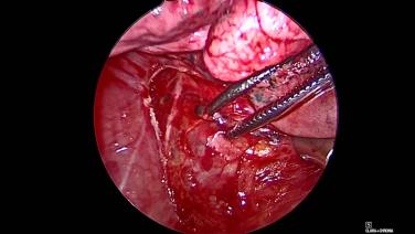 Thorascopic Lobectomy - Posterior Lymphadenectomy