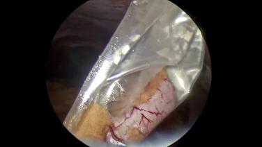 Laparoscopic Appendectomy - Specimen Removal