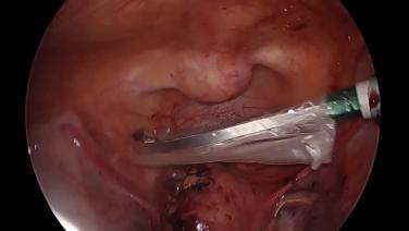 Laparoscopic Myomectomy - Specimen Removal