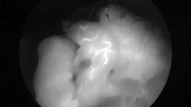 Laparoscopic Right Hemicolectomy - Extract Specimen