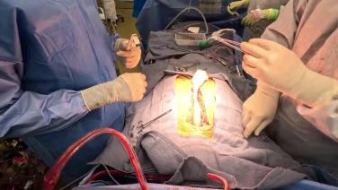 Coronary Artery Bypass Grafting (CABG) - Closure 1/2 - Sternal Wires