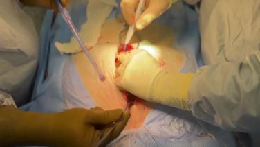 Coronary Artery Bypass Grafting (CABG) - Sternotomy