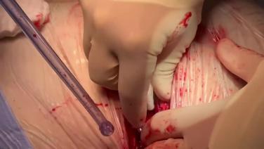 Coronary Artery Bypass Grafting (CABG) - Sternotomy Hemostasis