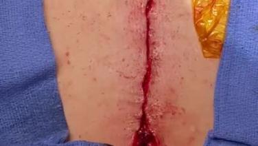 Mitral Valve Repair (MVR) - Closure STRATAFIX 1/3