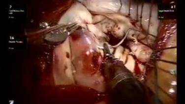 Mitral Valve Repair (MVR) - Annuloplasty 2/3