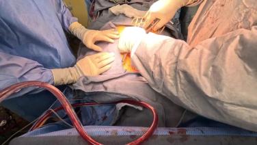 Coronary Artery Bypass Grafting (CABG) - Closure 2/2 - Tightening of Sternal Wires