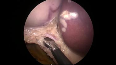 Laparoscopic Cholecystectomy - Identify Triangle of Calot