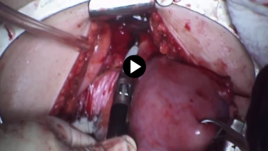 Total Abdominal Hysterectomy - Divide the Uterine Vessels
