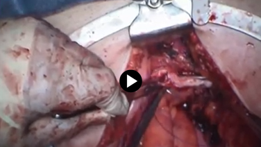 Total Abdominal Hysterectomy - Vaginal Closure