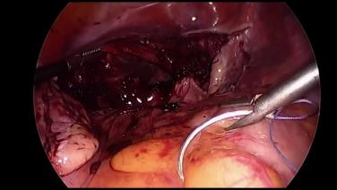 Total Laparoscopic Hysterectomy - Vaginal Cuff Closure
