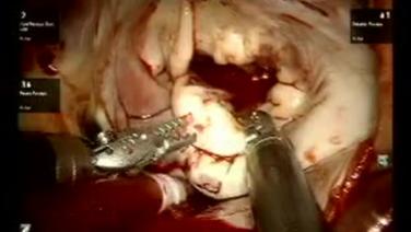 Mitral Valve Repair (MVR) - Valve Inspection