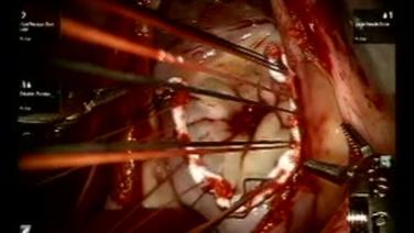 Mitral Valve Repair (MVR) - Annuloplasty 3/3