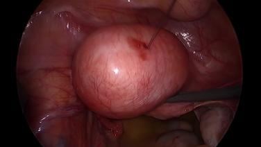 Laparoscopic Myomectomy - Locate Fibroid & Inject Vasopressin