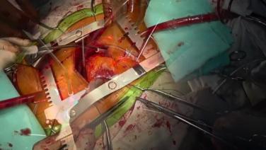 Aortic Valve Replacement (AVR) - Venous Cannula Placement