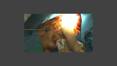 An image of the "Lobectomy Incision Location with Robert McKenna, MD" video.