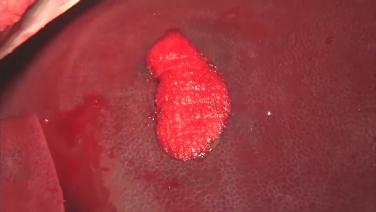 An image of the "SURGIFLO Hemostatic Matrix Kit in a Moderate Bleeding Liver Crack" video.