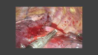 Repair during Right Upper Lobectomy with Zane Hammoud, MD