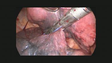 Fissure Transection During Right Upper Lobectomy by Zane Hammoud, MD