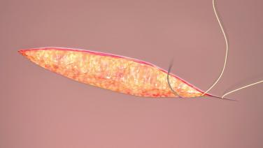 An image of the "Step-by-Step Suture Techniques" video.