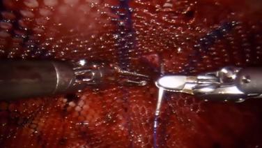 An image of the "Laparoscopic Inguinal Hernia Repair - TAPP with Steven Leeds, MD" video.