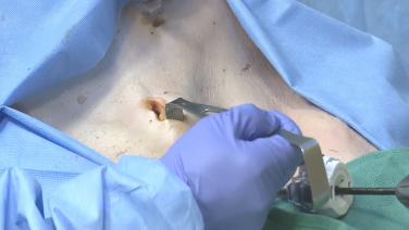 Laparoscopic Right Colectomy: Step 5 Exteriorize and Resect with David Longcope, MD