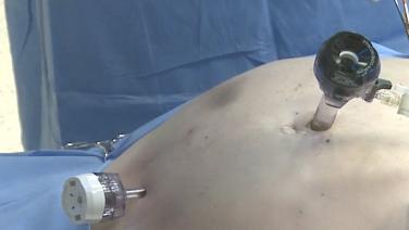 An image of the "Laparoscopic Left Colectomy & LAR - Step 1: Port Placement with David Longcope, MD" video.