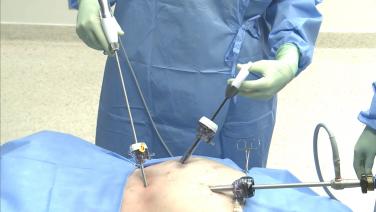 An image of the "Laparoscopic Left Colectomy & LAR - Step 2: Trendelenberg, Sweep SB, Ureter with David Longcope, MD" video.