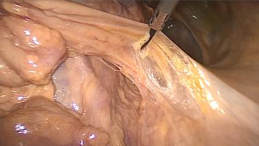 An image of the "Laparoscopic Left Colectomy & LAR - Step 5: Take Mesentry, Clean Rectum & Divide Bowel with David Longcope, MD" video.