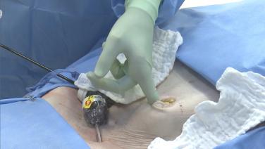 An image of the "Laparoscopic Left Colectomy LAR - Step 6c: Exteriorize, Resect, Anvil (Triple Staple) with David Longcope, MD" video.