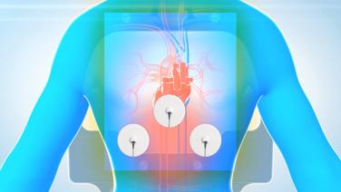 An image of the "CARTO® 3 System Patch Placement" video on the JnJInstitute.com website.