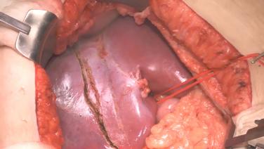 Formal Right Hepatectomy with Steven Trocha, MD