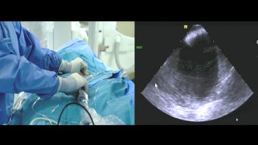 An image of the "Intracardiac Echo Views for Transseptal Puncture with Paul Zei, MD" video.