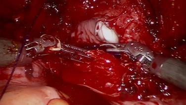 An image from the "Initiating Robotic Vaginal Cuff Closure with STRATAFIX Spiral PDS Plus with Dwight Im, MD" video on the jnJInstitute.com website.