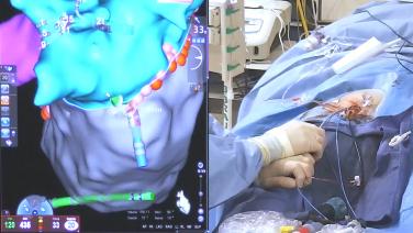 An image of the "Creating RF Lesion Sets During the AF Procedure with Brett Gidney, MD" video on the JnJInstitute.com website.