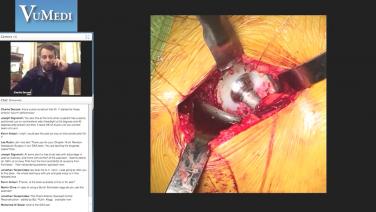 Anterior Approach Femoral Revision with Charles DeCook, MD
